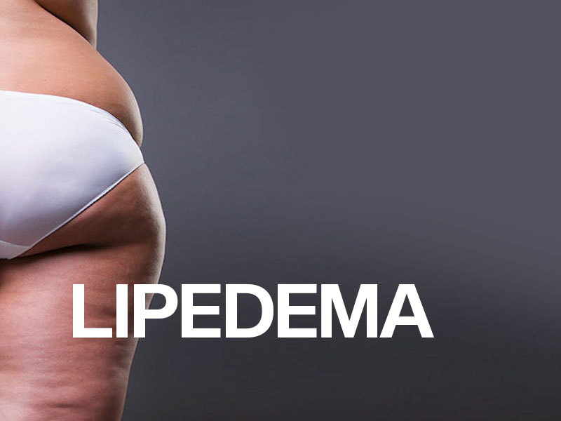 What Is Lipoedema? All Wanted To Known About Lipoedema