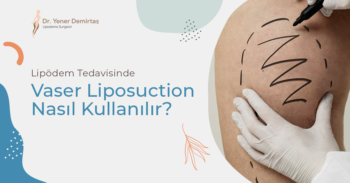Lipödem Tedavisinde Vaser Liposuction Nasıl Kullanılır?